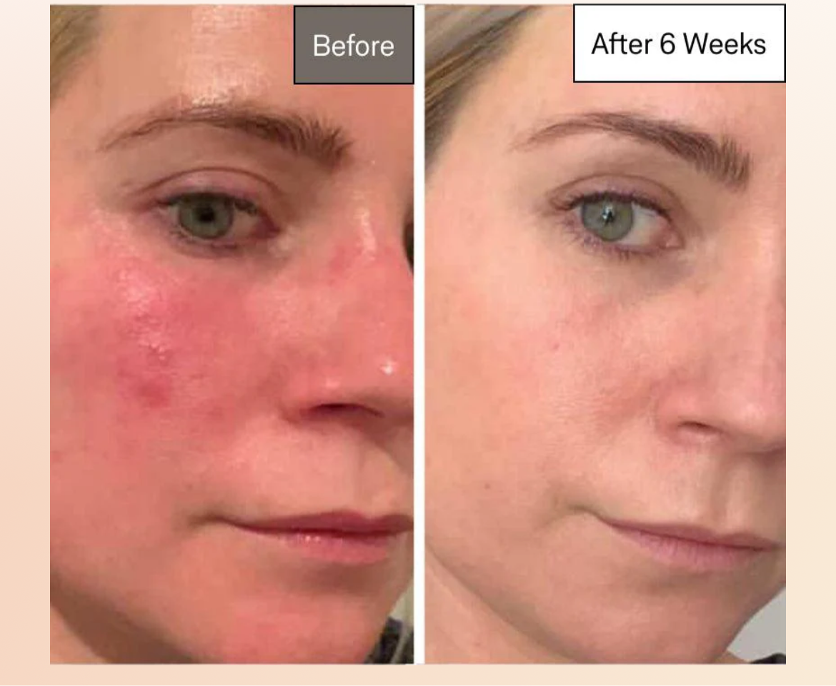 Omnilux Contour LED Mask